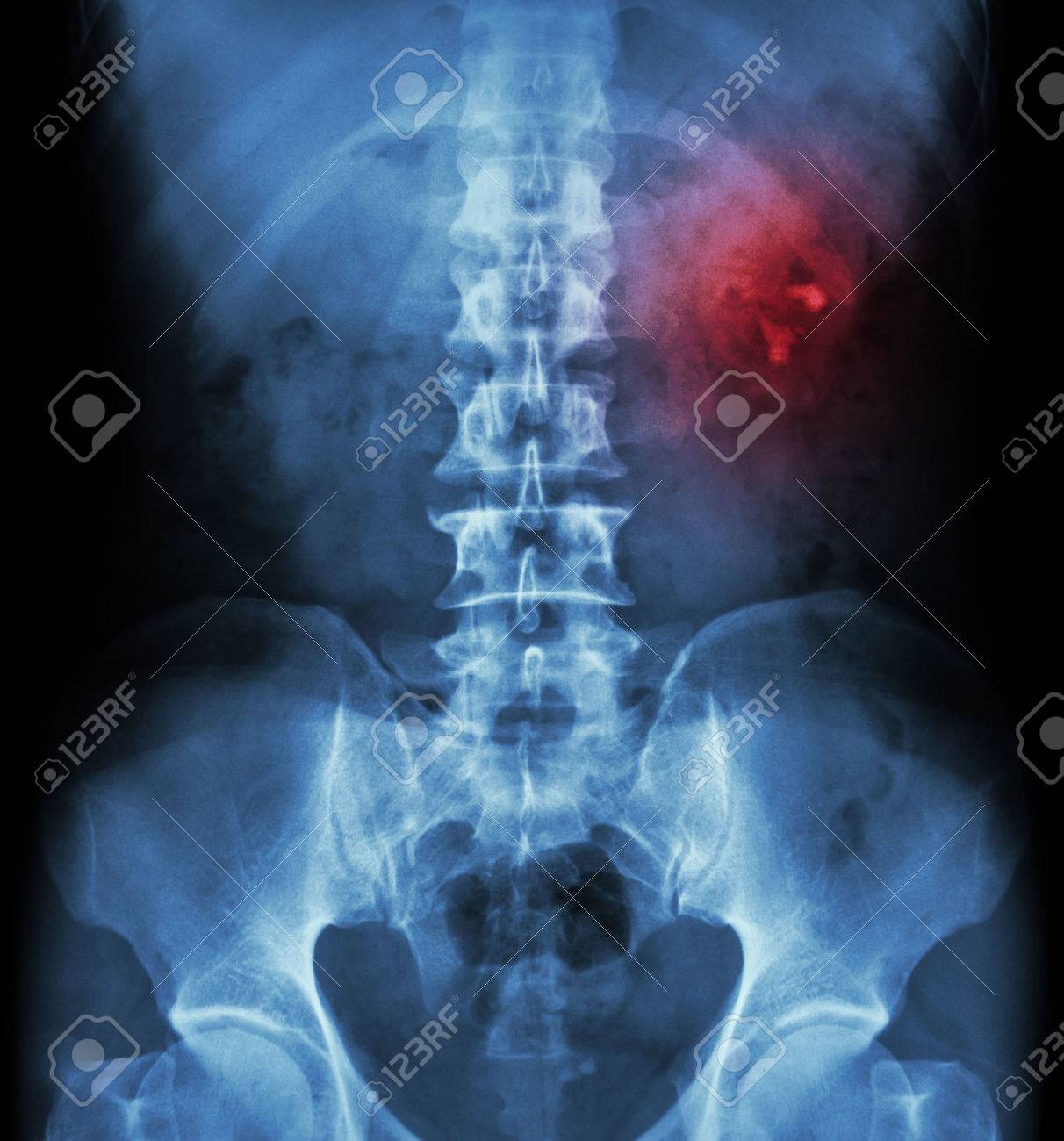 Kidney stone ( renal stone , renal calculi ) ( film x-ray KUB ( Kidney - Ureter - Bladder ) show left renal stone ) - 47419527 Kidney stone ( renal stone , renal calculi ) ( film x-ray KUB ( Kidney - Ureter - Bladder ) show left renal stone ) - 47419527