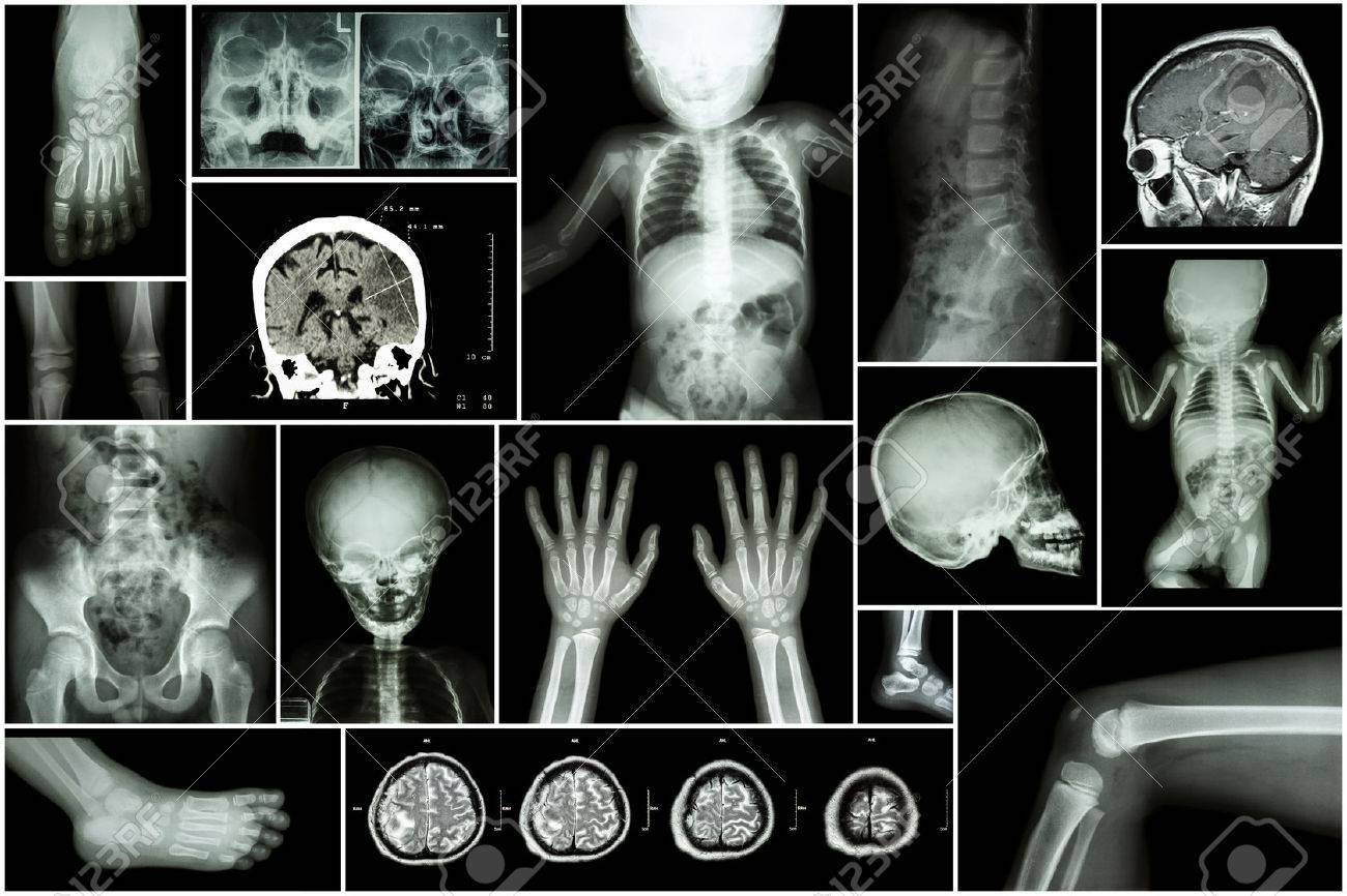 X-ray multiple part of child 's body & multiple disease ( stroke , brain tumor , rheumatoid arthritis , sinusitis , gouty arthritis , etc)( skull chest lung heart spine arm hand pelvis leg knee foot ) - 47591213 X-ray multiple part of child 's body & multiple disease ( stroke , brain tumor , rheumatoid arthritis , sinusitis , gouty arthritis , etc)( skull chest lung heart spine arm hand pelvis leg knee foot ) - 47591213