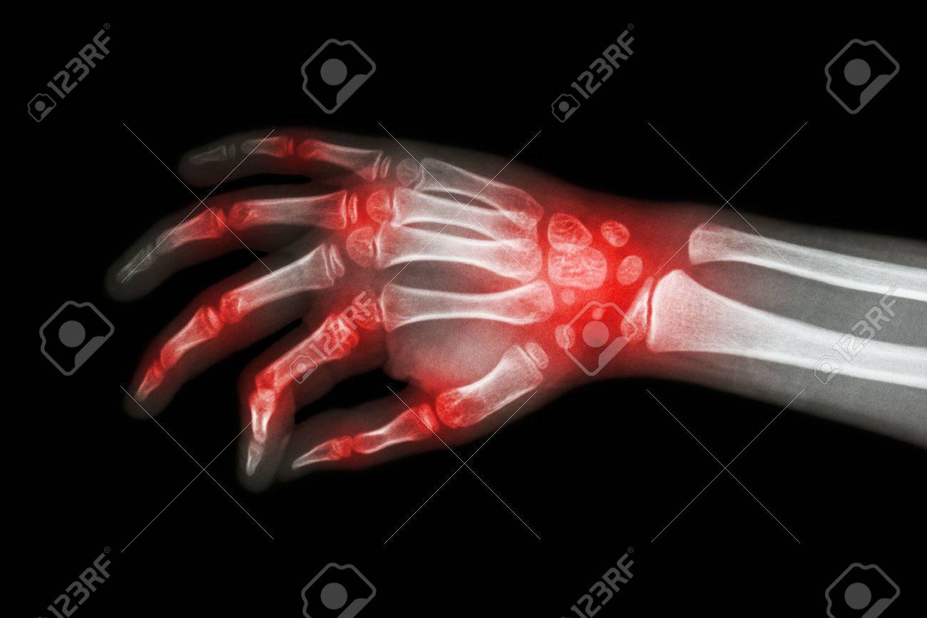Rheumatoid arthritis , Gouty arthritis ( Film x-ray hand of child with arthritis at multiple joint ) - 49969190 Rheumatoid arthritis , Gouty arthritis ( Film x-ray hand of child with arthritis at multiple joint ) - 49969190