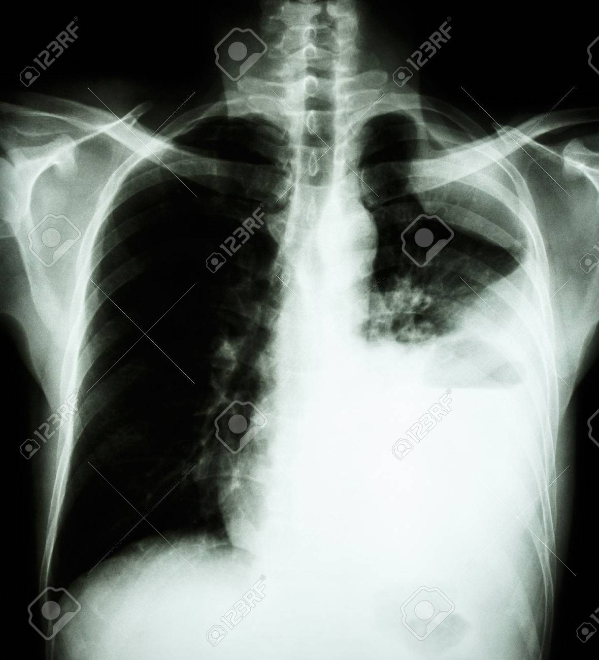 Derrame pleural en ingles