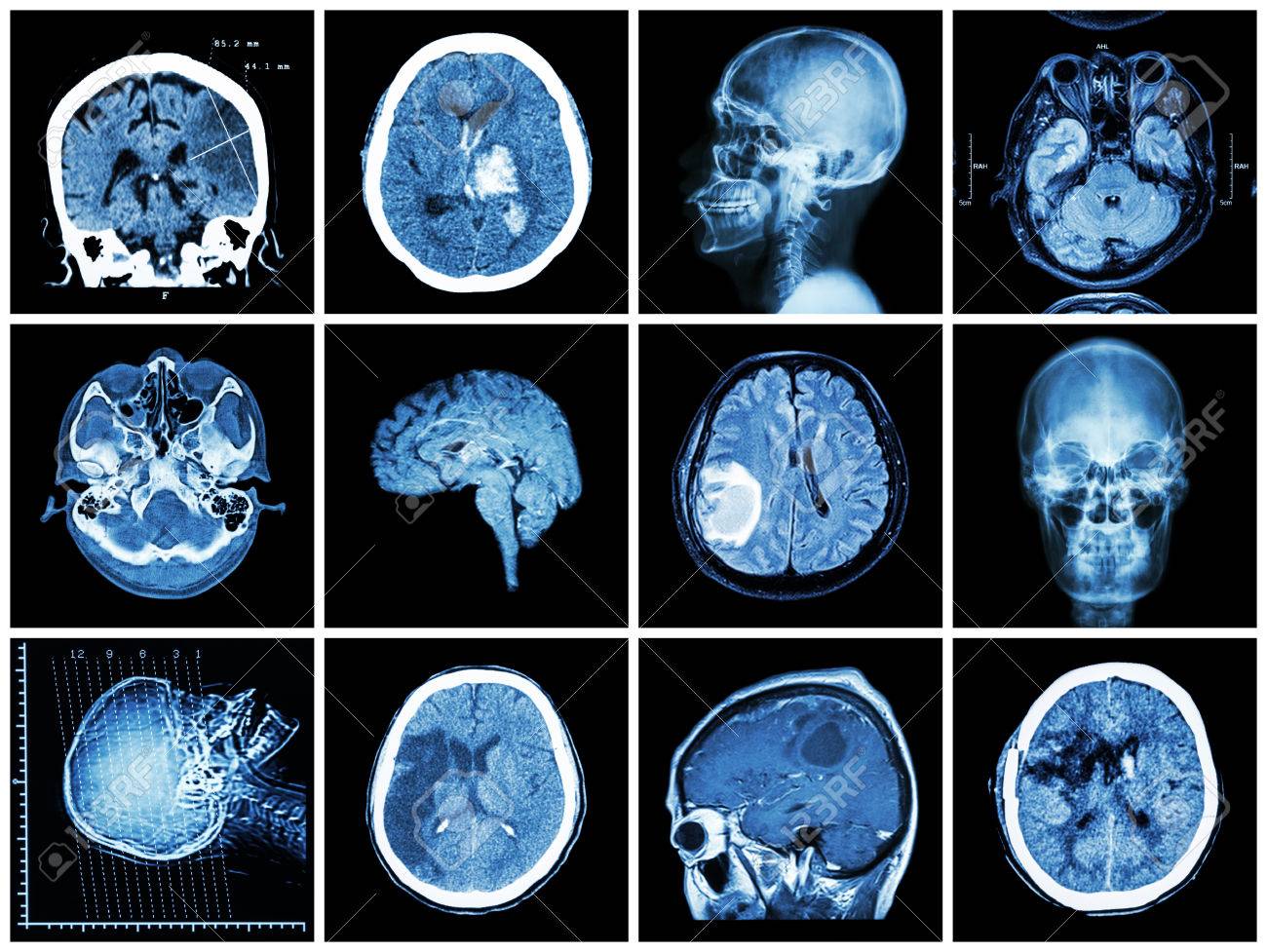 Que es resonancia magnetica cerebral