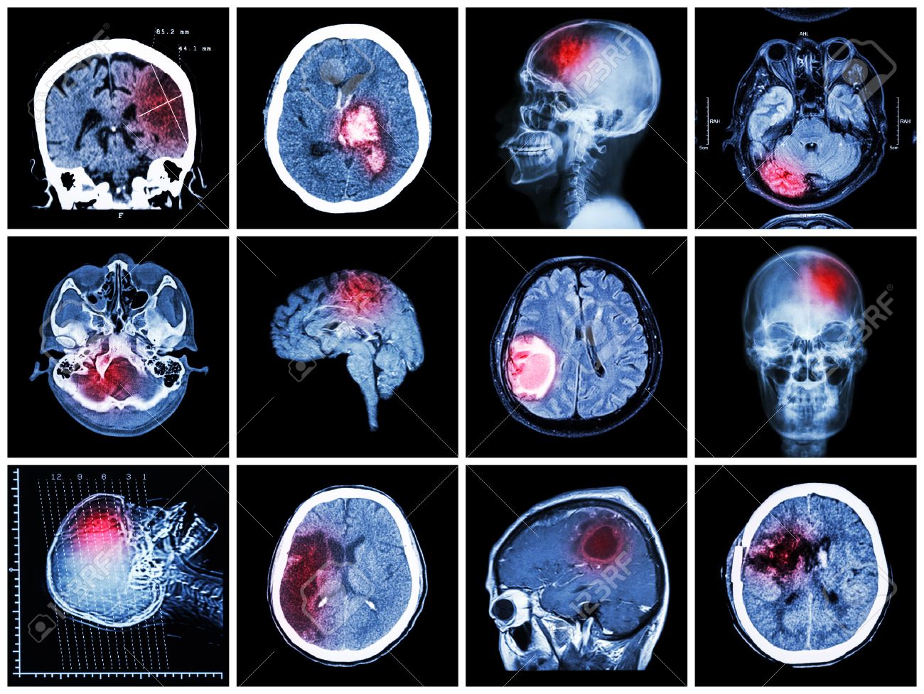 collection of brain disease ct scan and mri of brain show ct scan brain