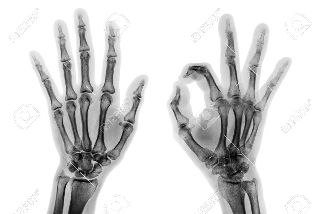 X - ray both hands with OK sign . - 82153046 X - ray both hands with OK sign . - 82153046