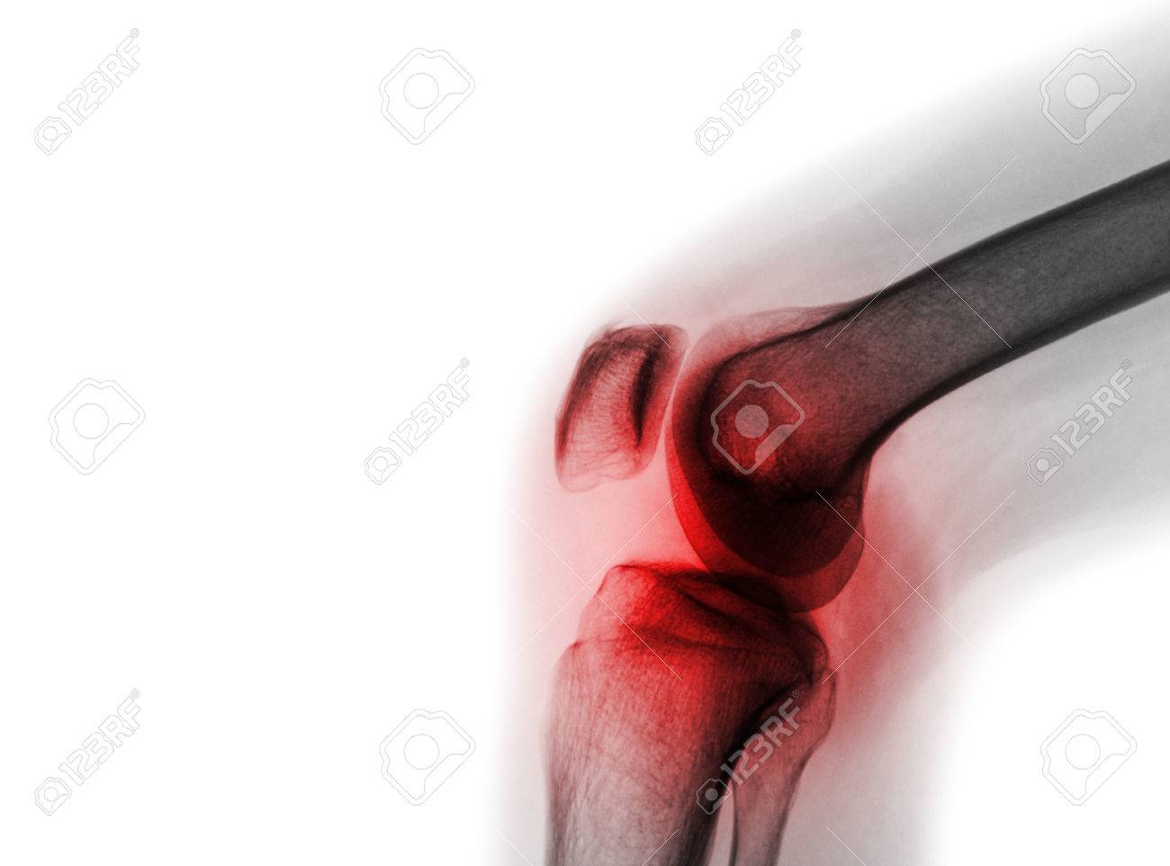 Film Rontgen Kniegelenk Mit Arthritis Gicht Rheumatoide Arthritis Septische Arthritis Osteoarthritis Knie Und Leere Flache Auf Der Linken Seite Lizenzfreie Fotos Bilder Und Stock Fotografie Image 82172563