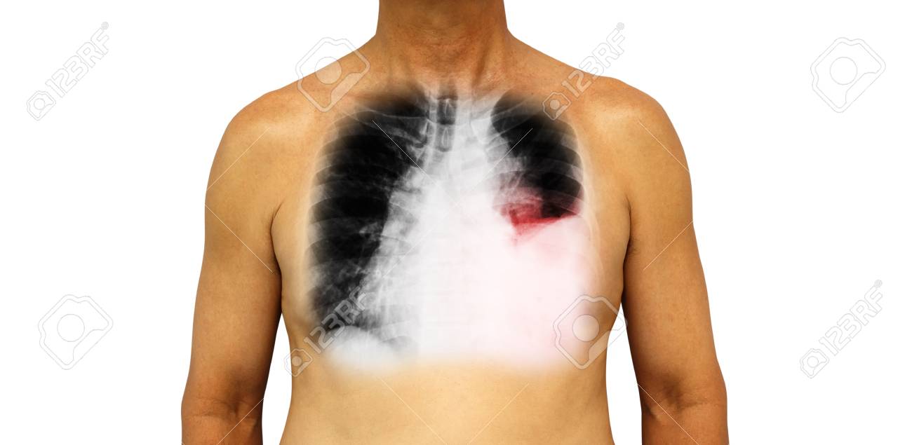 Lung cancer . Human chest and x-ray show pleural effusion left lung due to lung cancer . - 83654062 Lung cancer . Human chest and x-ray show pleural effusion left lung due to lung cancer . - 83654062