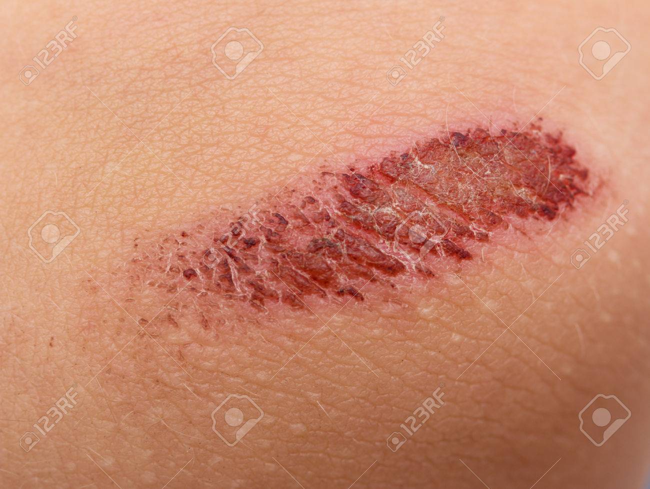 abrasion on the skin stock photo picture and royalty free image