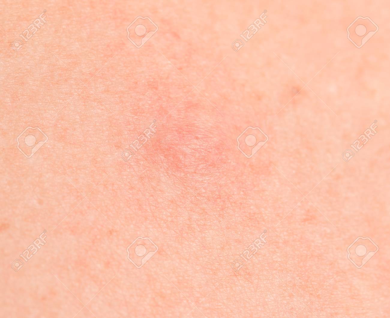 太陽から皮膚に赤い斑点 の写真素材 画像素材 Image