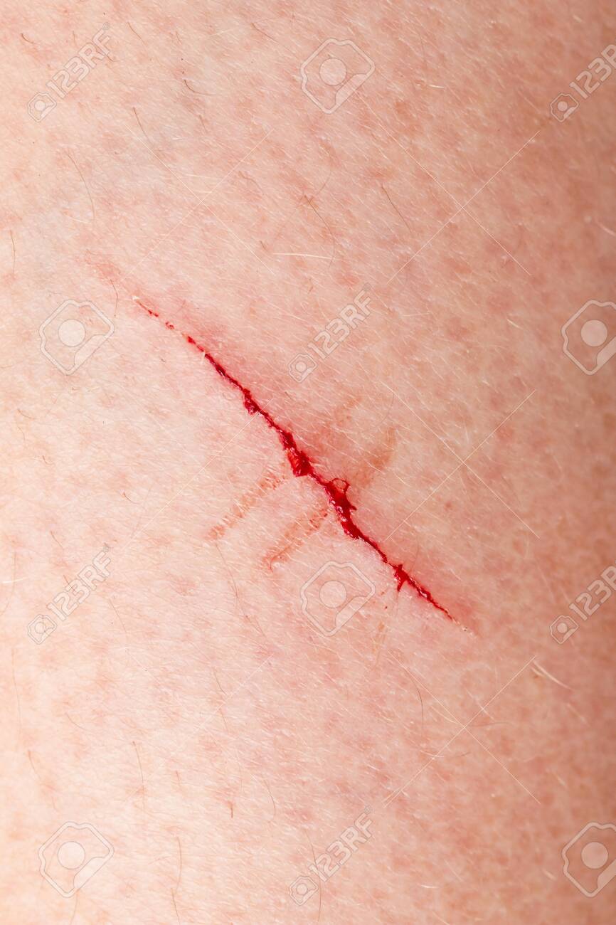 Scratch On The Skin Of A Child S Hand Stock Photo Picture And Royalty Free Image Image 125231741