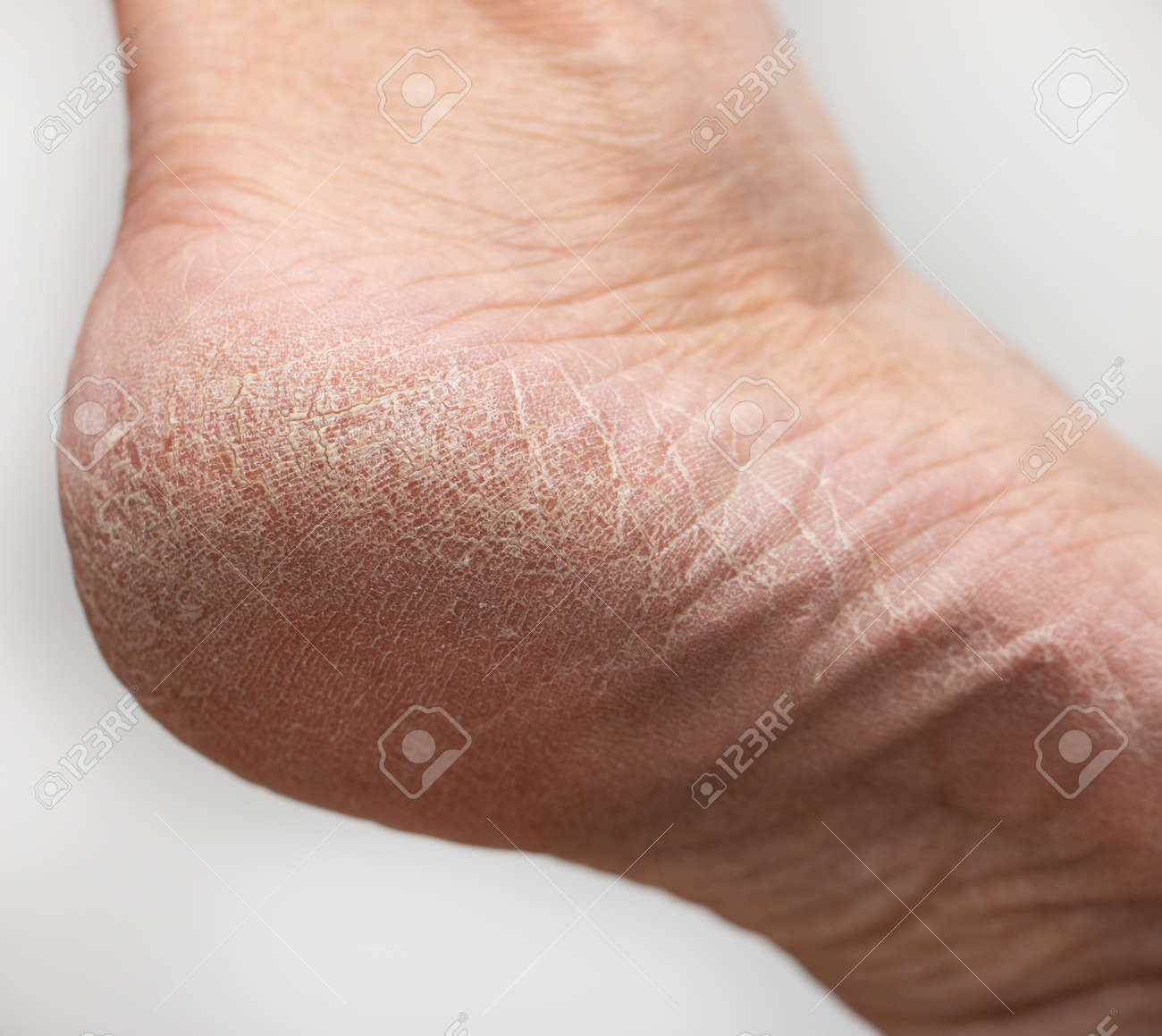 Corns Callus Cracks In Feet Reasons Foot On A Black Background