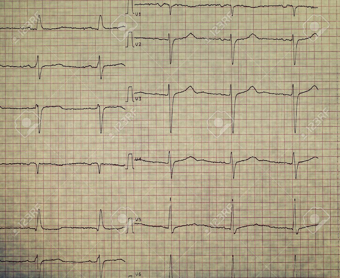 ecg on the plotting paper stock photo picture and royalty free
