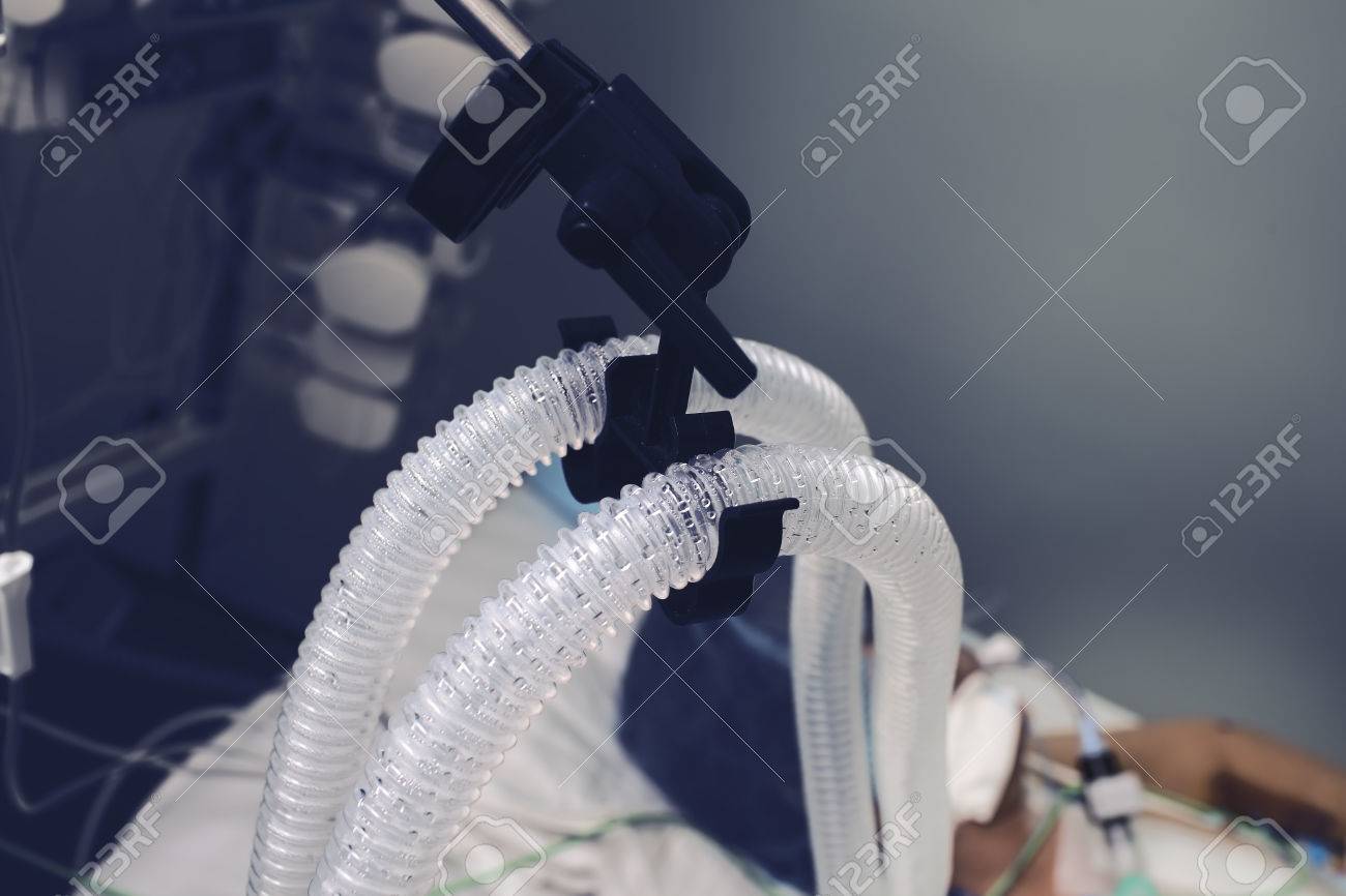 Condensed vapor on the patient breathing tube. - 83546987 Condensed vapor on the patient breathing tube. - 83546987