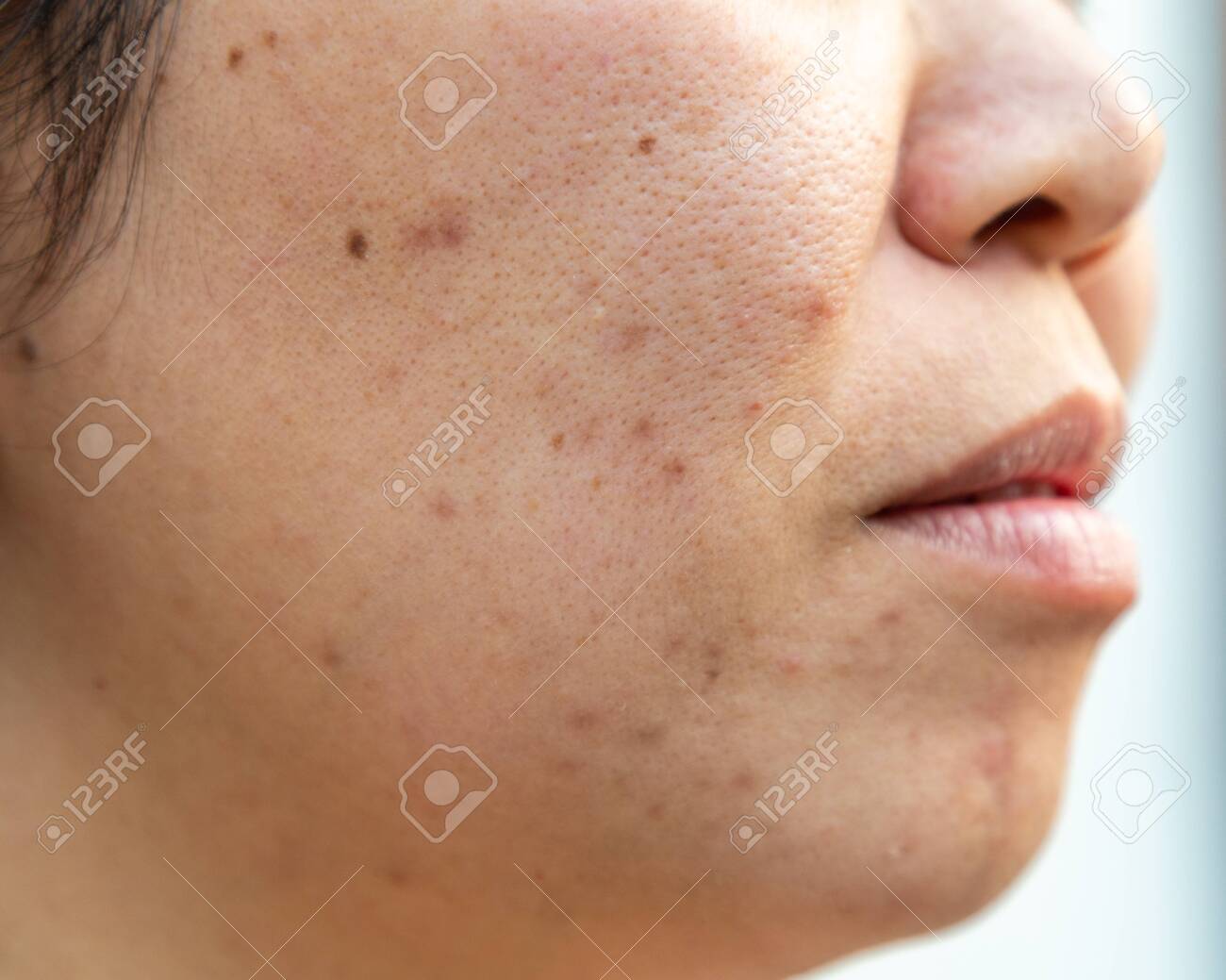 facial blemishes