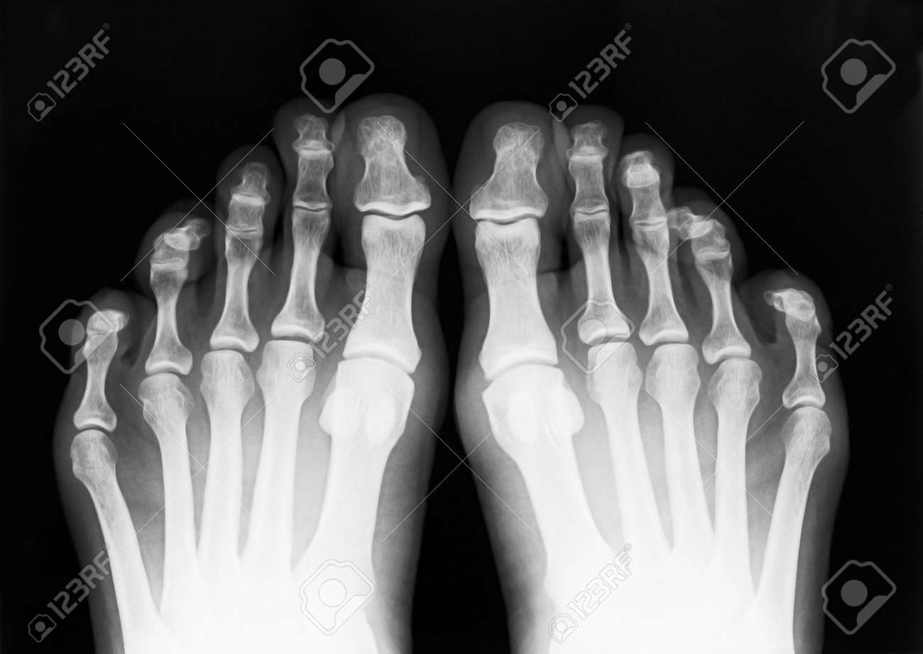 Foot Doigts Exposes Sur X Ray Film Noir Et Blanc Banque D Images Et Photos Libres De Droits Image