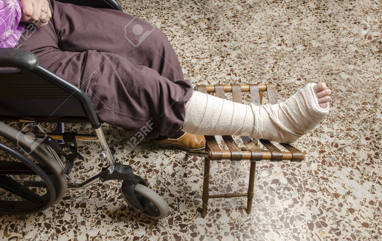 Woman With Her Broken Leg. Arm In A Cast, Face Not Visible Over White.  Stock Photo, Picture and Royalty Free Image. Image 69712485., image size:1300x821