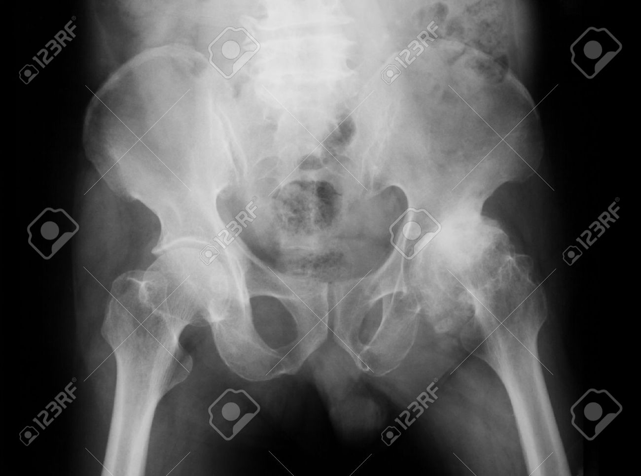 Stock Photo X Ray Image Of Both Hip Ap View Show Left Hip Osteoarthritis Degenerative Arthritis Of The Hip Stock Photo X Ray Image Of Both Hip Ap View Show Left Hip Osteoarthritis Degenerative Arthritis Of The Hip