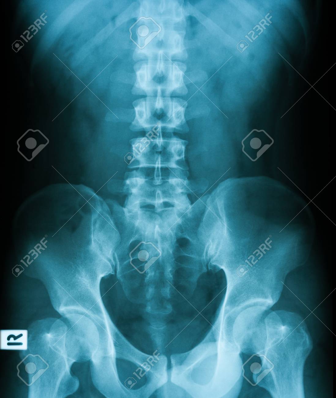 Xray Image Of Plain Kub Normal Stock Photo Picture And Royalty Free Image Image 39411256