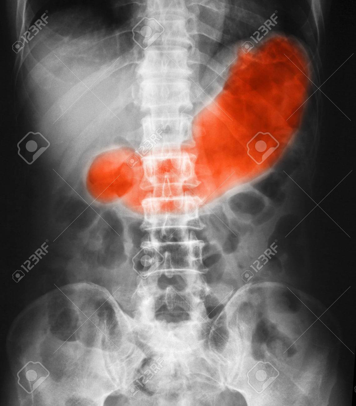 腹部の X 線イメージは胃や潰瘍を示します。の写真素材・画像