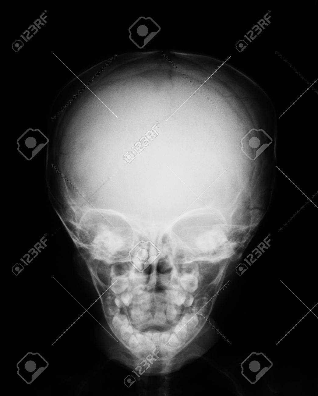 Crane Bebe X Ray Image Banque D Images Et Photos Libres De Droits Image