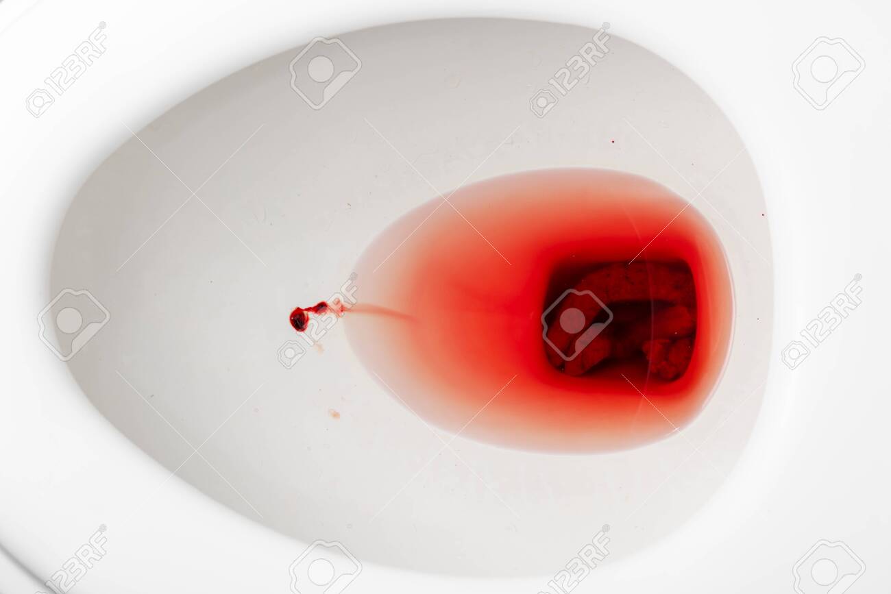 Blood Mixed With The Feces Of People With Hemorrhoids In Flush Toilet.  Stock Photo, Picture And Royalty Free Image. Image 140455789.