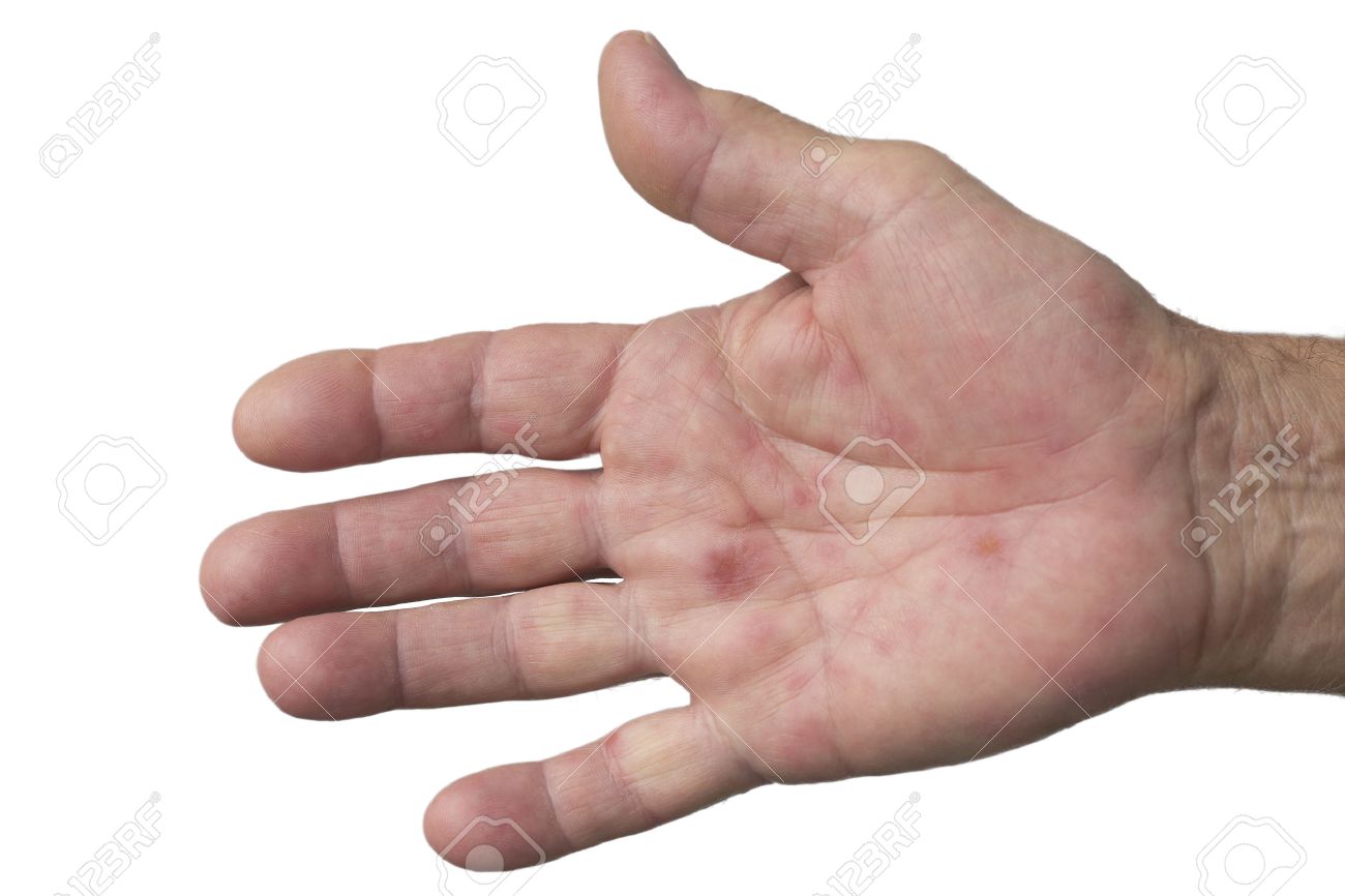 mano, fiebre aftosa, mucha picazón