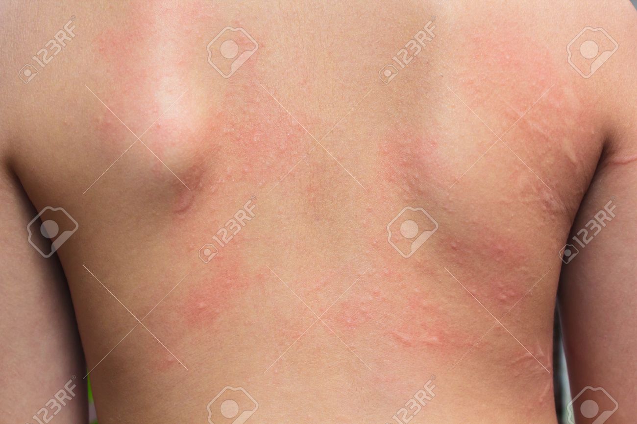 Human Skin Presenting An Allergic Reaction Allergic Rash Stock Photo 32324362 Human Skin Presenting An Allergic Reaction Allergic Rash Stock Photo 32324362