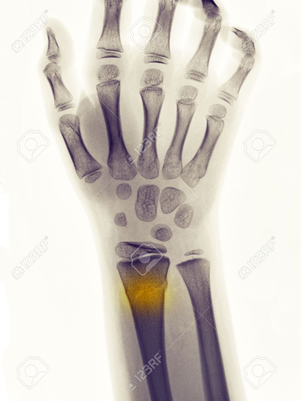 x ray showing a greenstick fracture of the distal radius in a greenstick fracture