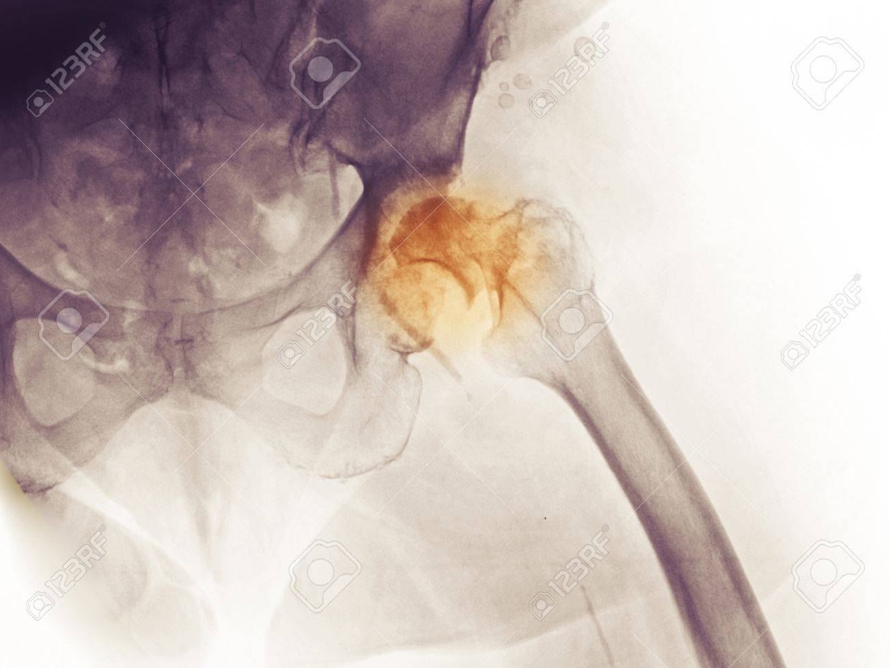 X Ray Von Der Hufte Und Becken Einer 83 Jahre Alte Frau Mit Einer Geschichte Von Degnerative Gelenkerkrankung Das Rontgenbild Zeigt Schwere Djd Der Hufte Sowie Einen Bruch Des Halses Des Oberschenkels Lizenzfreie
