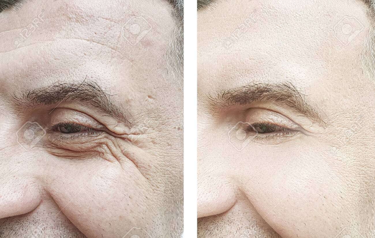 male eye wrinkles