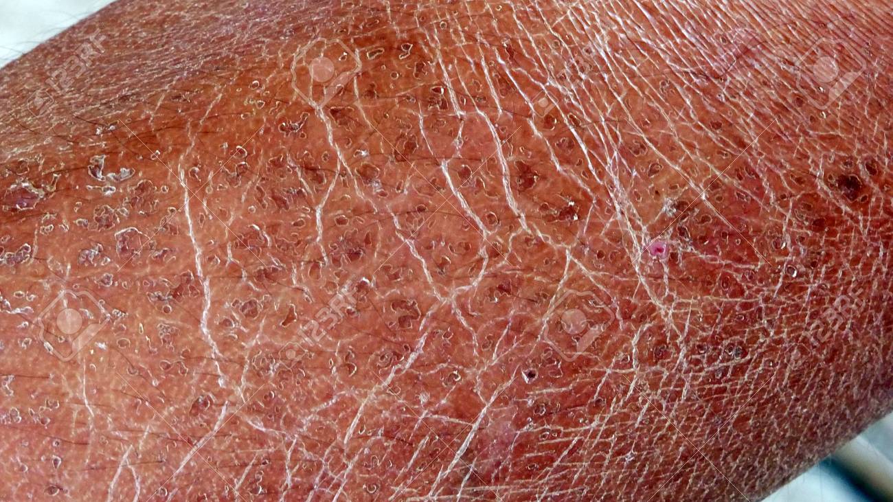 dry rough skin dry rough skin