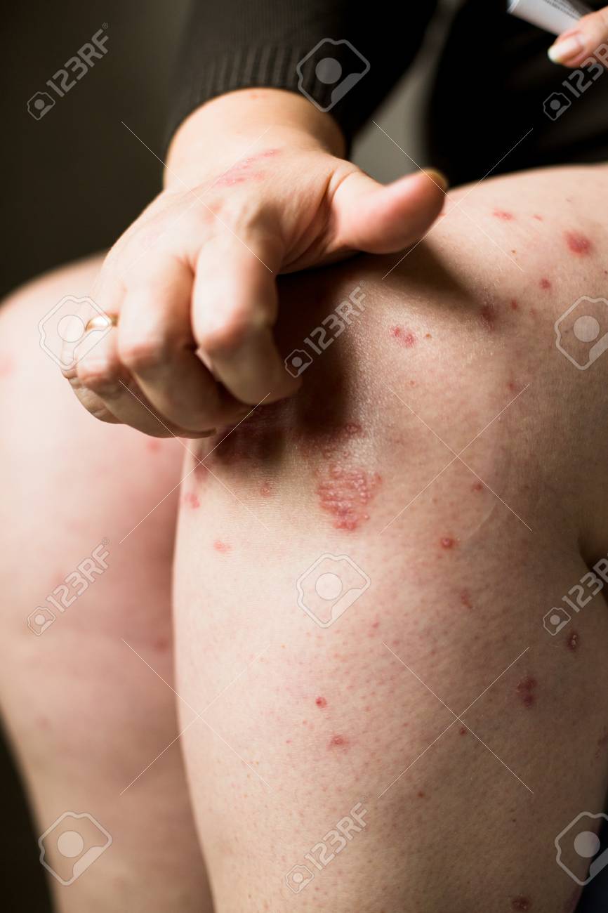 多くの人々との問題 手の皮膚に湿疹や乾癬 女性は足の乾燥した皮膚をかねかけた 病気のアレルギー性発疹 の写真素材 画像素材 Image