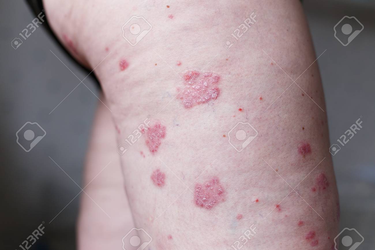 Allergic Rash Dermatitis Eczema Skin On Leg Of Patient Psoriasis Stock Photo Picture And Royalty Free Image Image