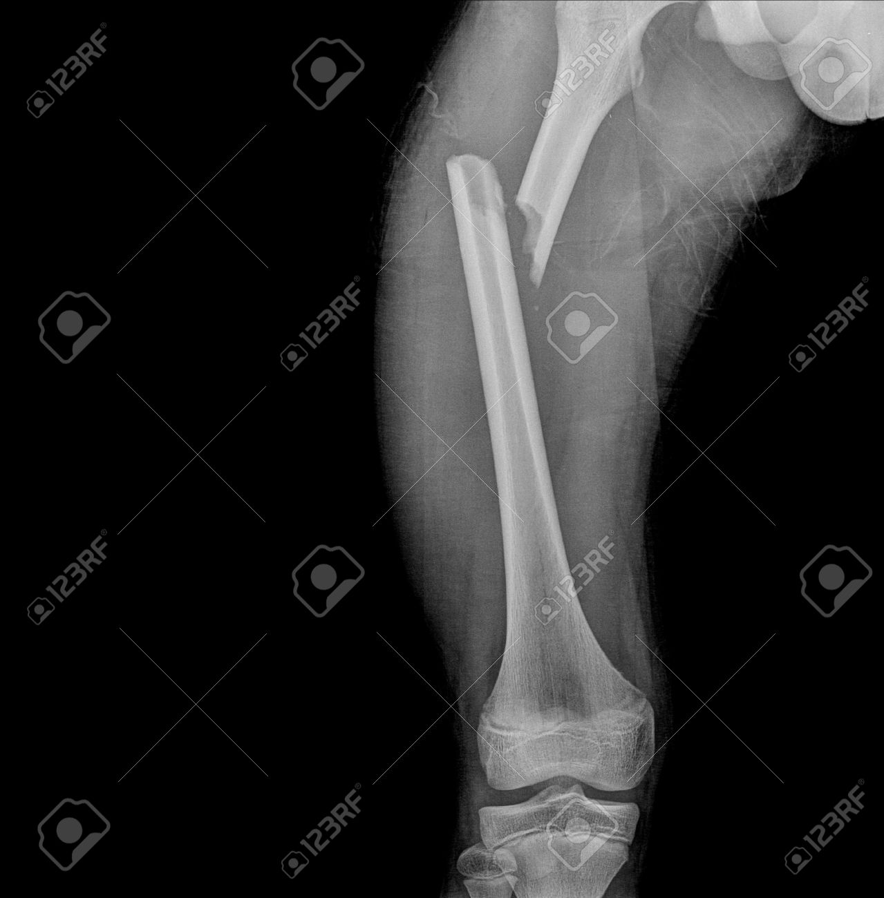 Broken Human Thigh X-rays Image ,Right Leg Fracture Stock Photo, Picture  and Royalty Free Image. Image 34033799., image size:1279x1300