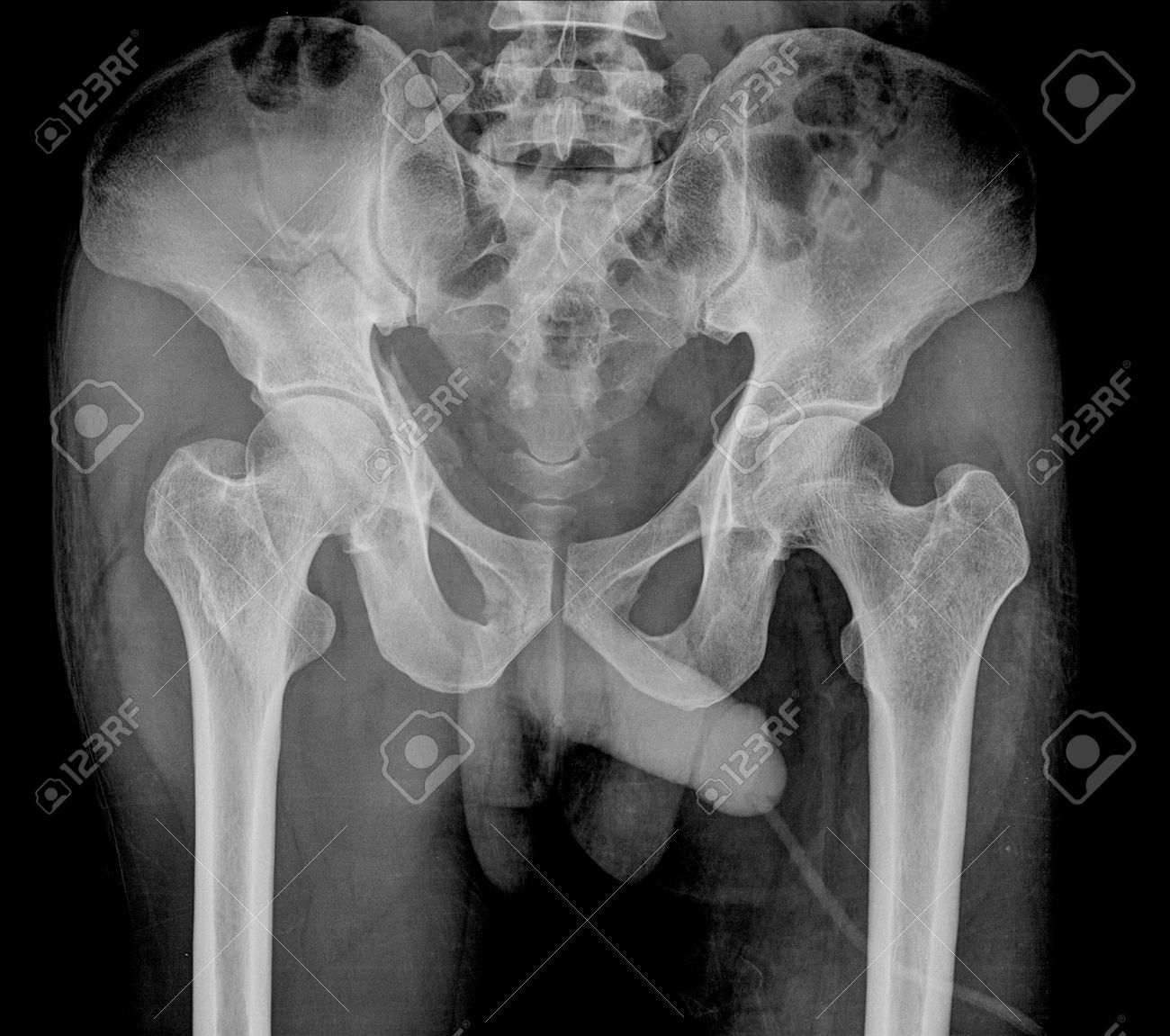 X Ray Image Pelvis And Hip Of A Man Stock Photo Picture And Royalty Free Im...