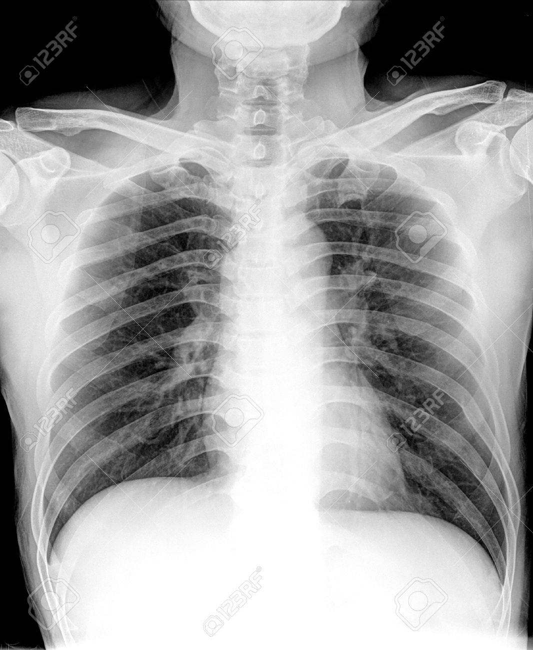 derrame pleural in english derrame pleural in english