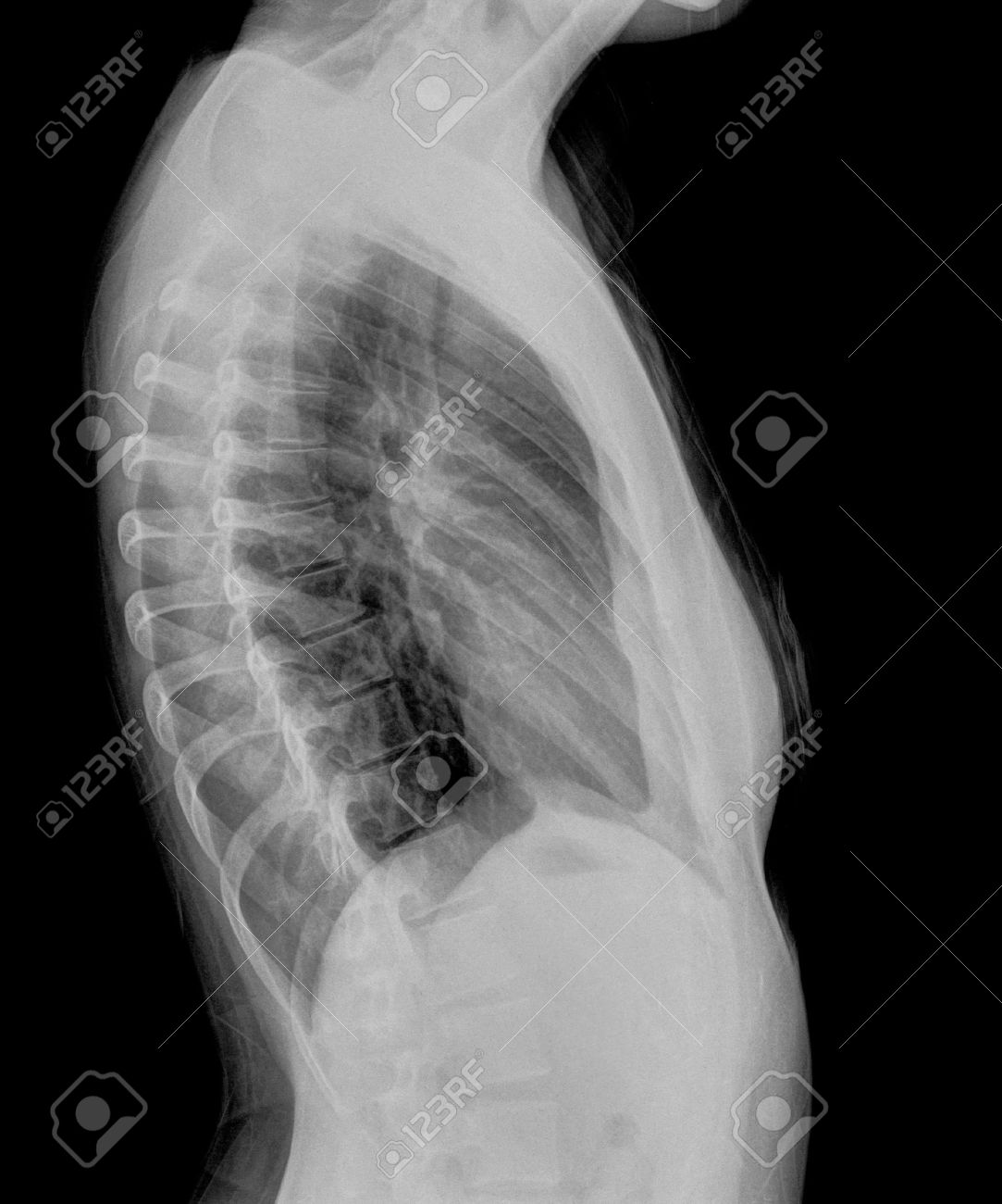 human thorax radiography side view chest x ray stock photo