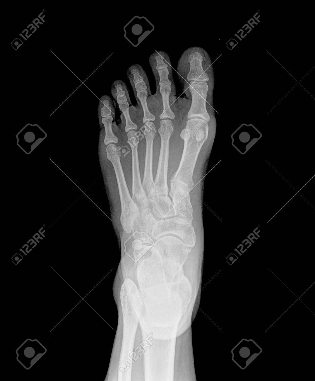 X,ray human\u0027s ankle with arthritis , top view