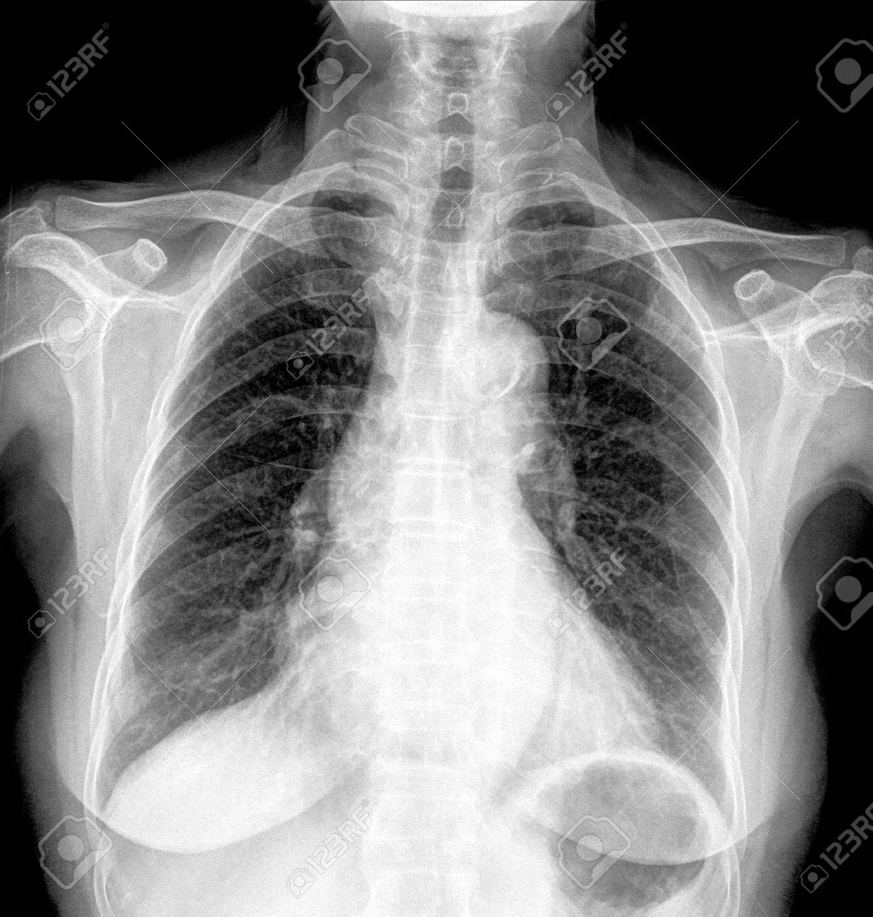 a chest xray scan for a medical diagnosis stock photo picture and chest xray