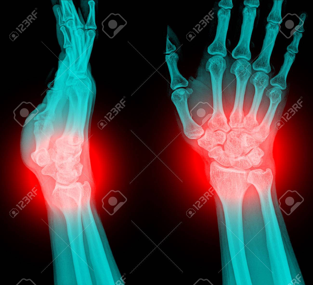 Un poignet cassé Clearance