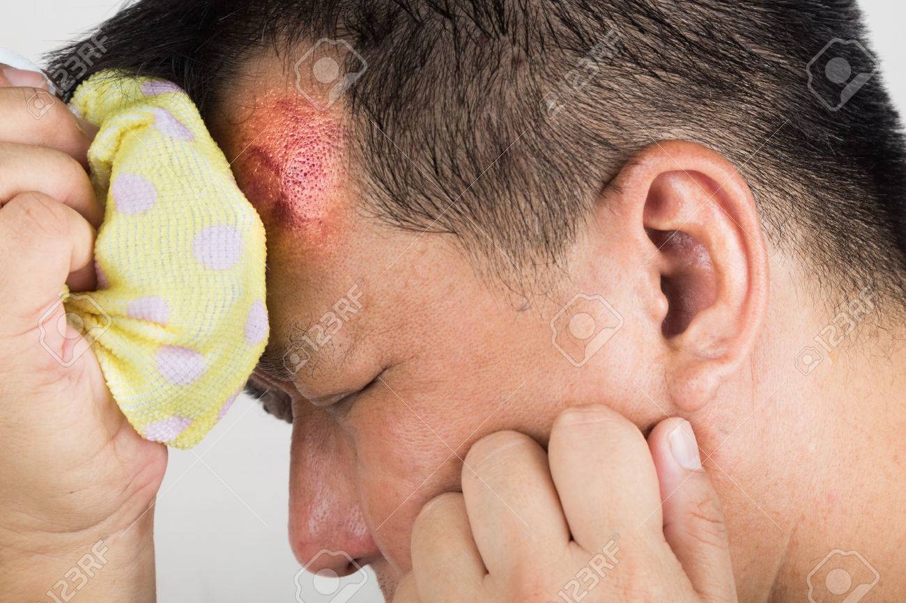 closeup on man treating his injured painful swollen forehead stock