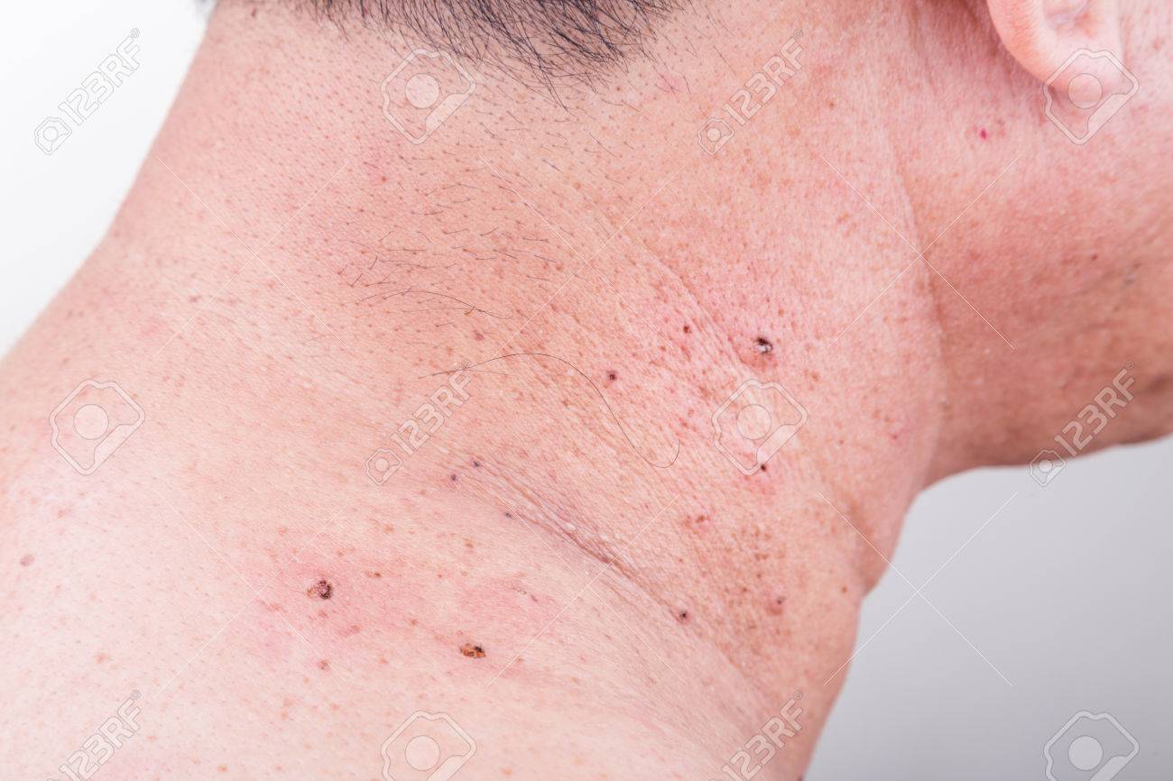Mole Enlevé Du Cou Et De L épaule Par Procédure De Greffe De Peau Laissant Cicatrice Sur L Homme Asiatique Banque D Images Et Photos Libres De Droits Image 75022851