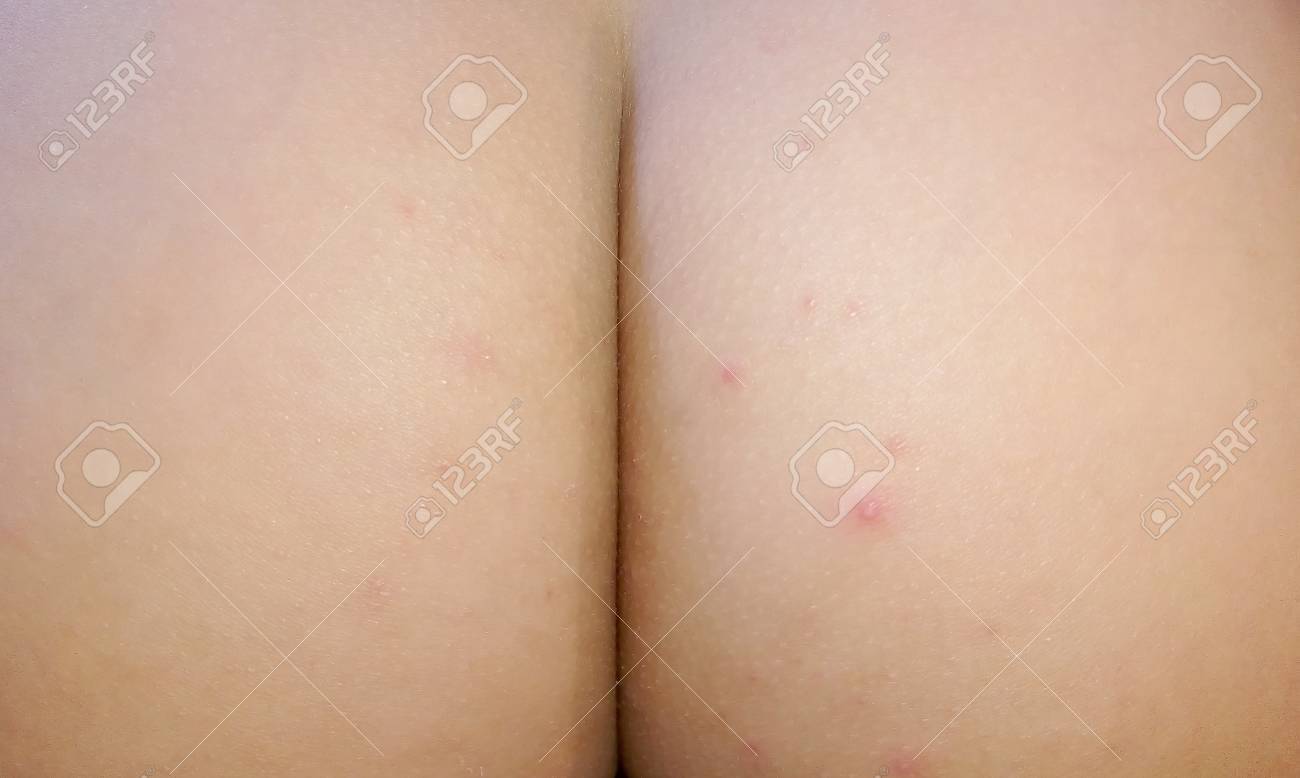 お尻の子供の発疹 の写真素材 画像素材 Image