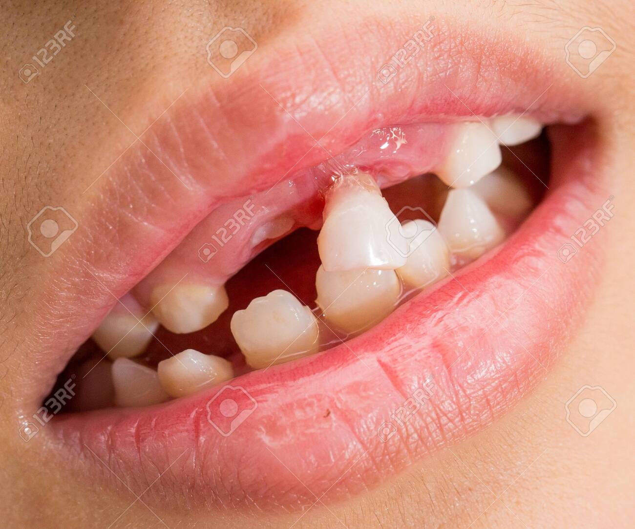 Milk teeth that are about to fall - 145977369 Milk teeth that are about to fall - 145977369