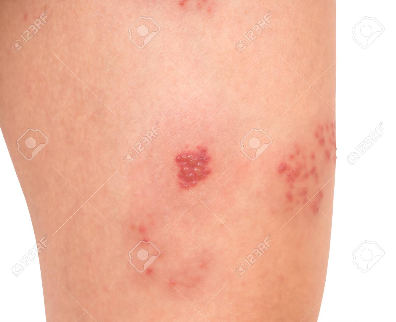 Herpès Sur La Face Interne De La Cuisse