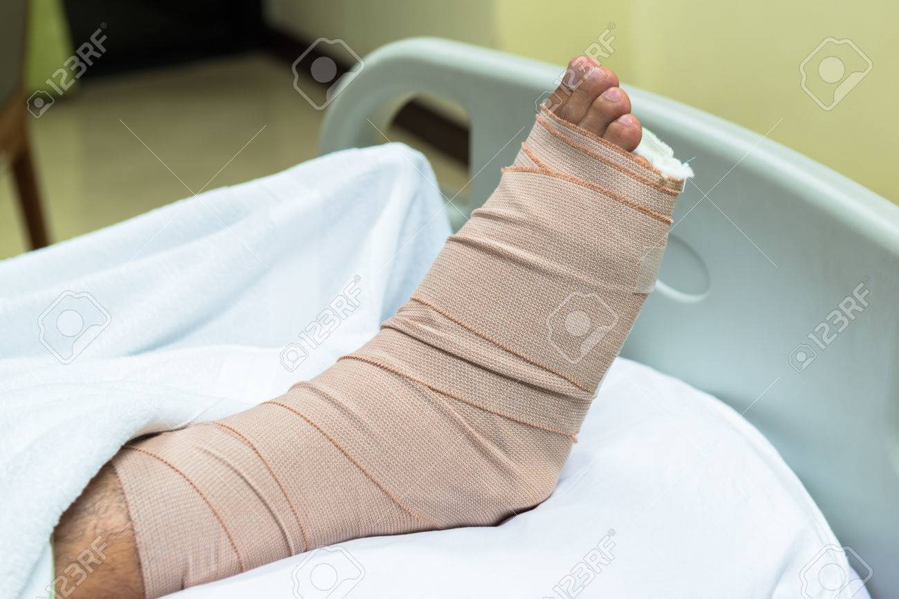 Patient With Broken Leg In Cast And Bandage Stock Photo, Picture and  Royalty Free Image. Image 34855736., image size:1300x867