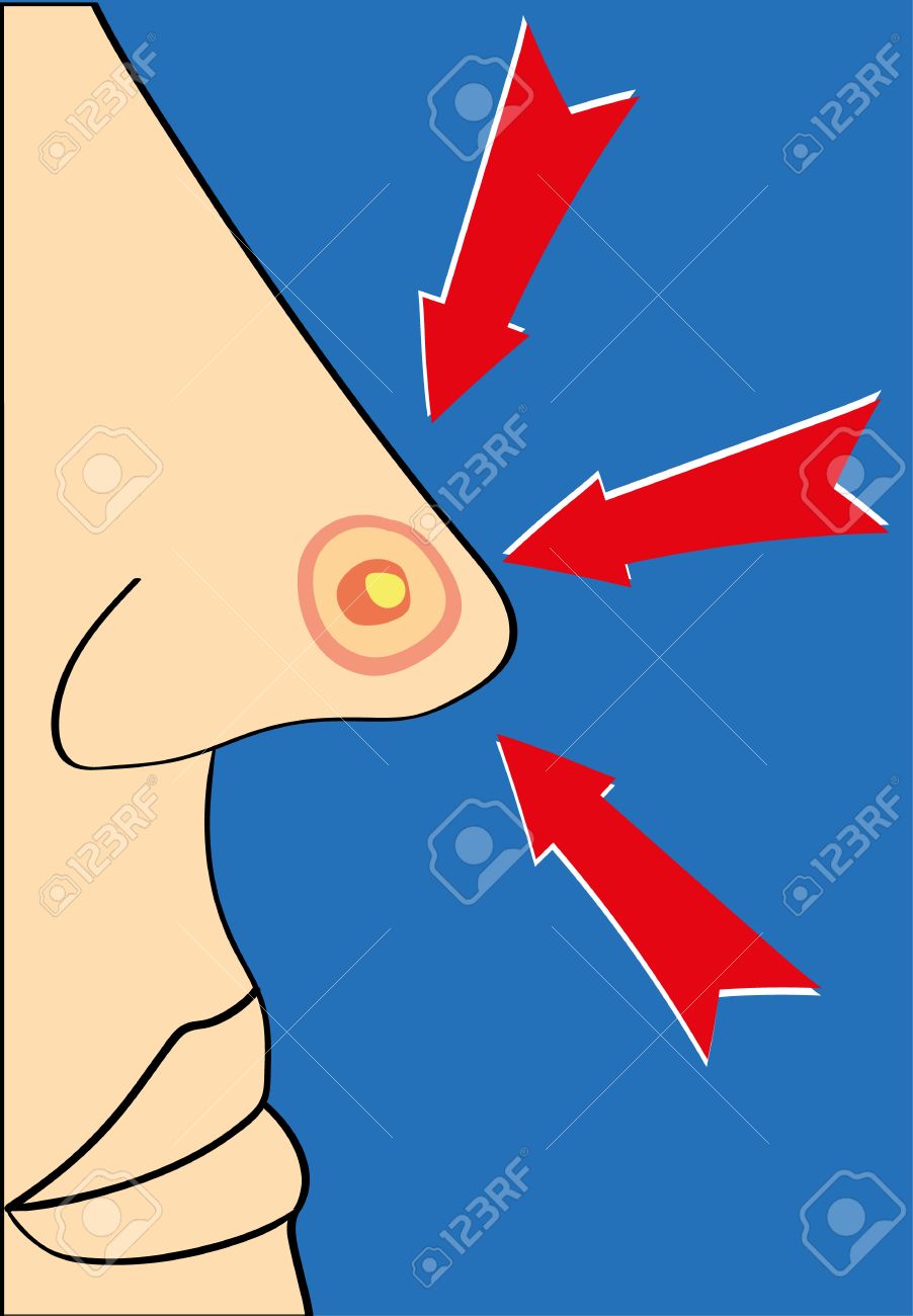 大きな赤い斑点や白い頭と 3 つの赤い矢印がそれを指しているとにきびと鼻のクローズ アップのイラスト素材 ベクタ Image