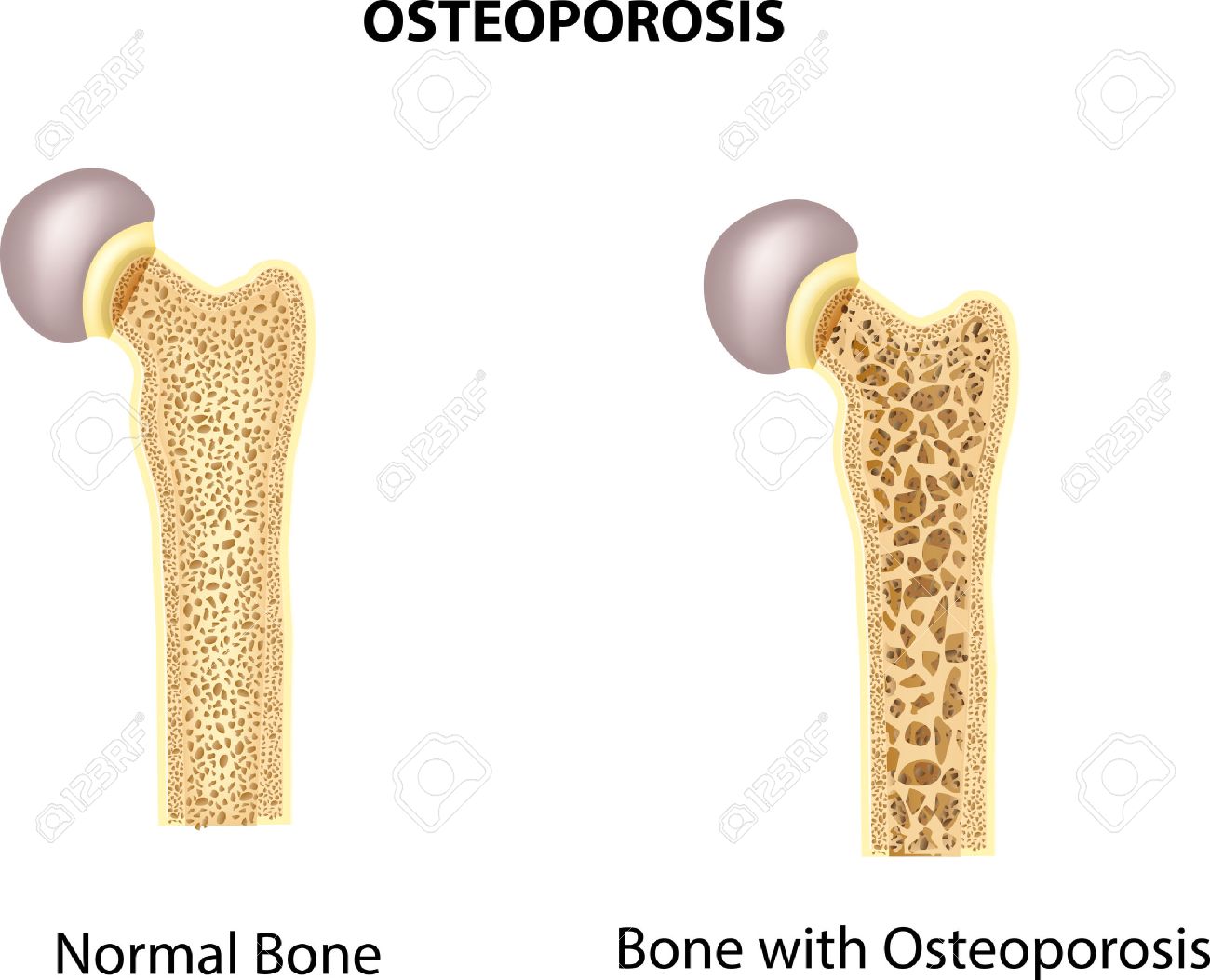 Vector illustration of bone of hip. normal bone and bone with osteoporosis - 53334715 Vector illustration of bone of hip. normal bone and bone with osteoporosis - 53334715