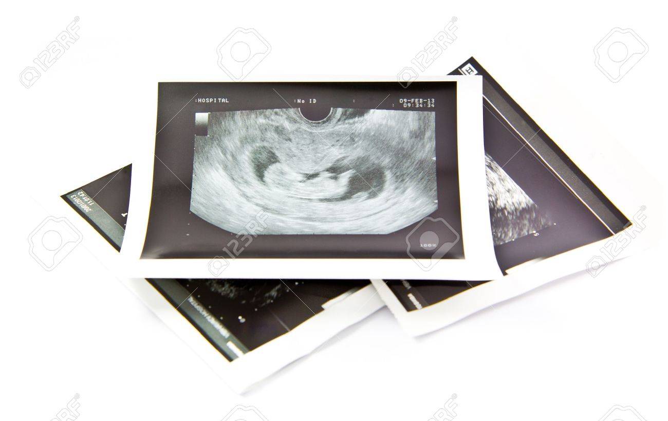 12 Semaines Bebe Echographie Image Banque D Images Et Photos Libres De Droits Image 3549