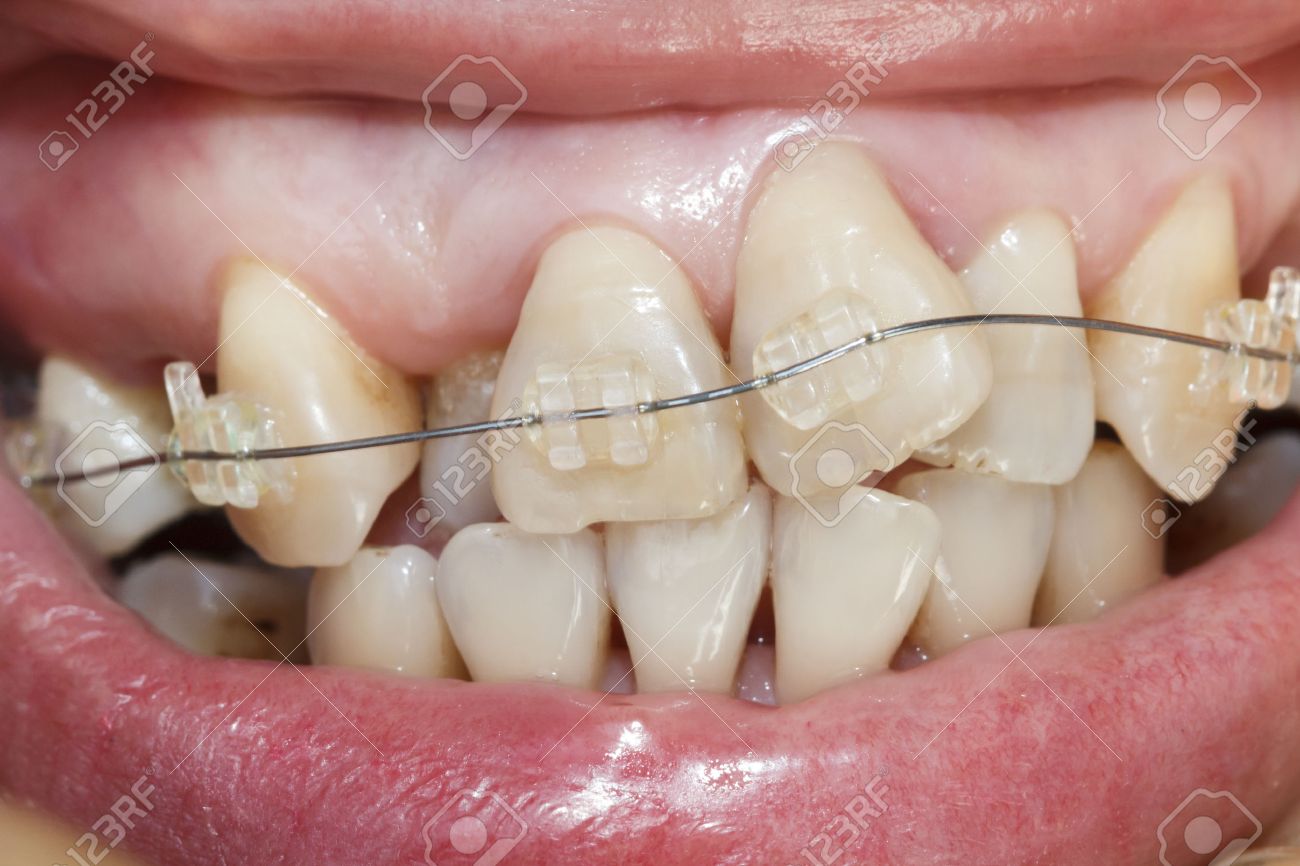 36486450-close-up-mouth-of-crooked-teeth-with-braces.jpg