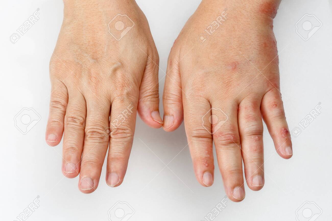 Cierto límite Moderar Herpes Zóster Que Causa Hinchazón En La Mano Fotos, Retratos, Imágenes Y Fotografía De Archivo Libres De Derecho. Image 131795228. Cierto límite Moderar Herpes Zóster Que Causa Hinchazón En La Mano Fotos, Retratos, Imágenes Y Fotografía De Archivo Libres De Derecho. Image 131795228.