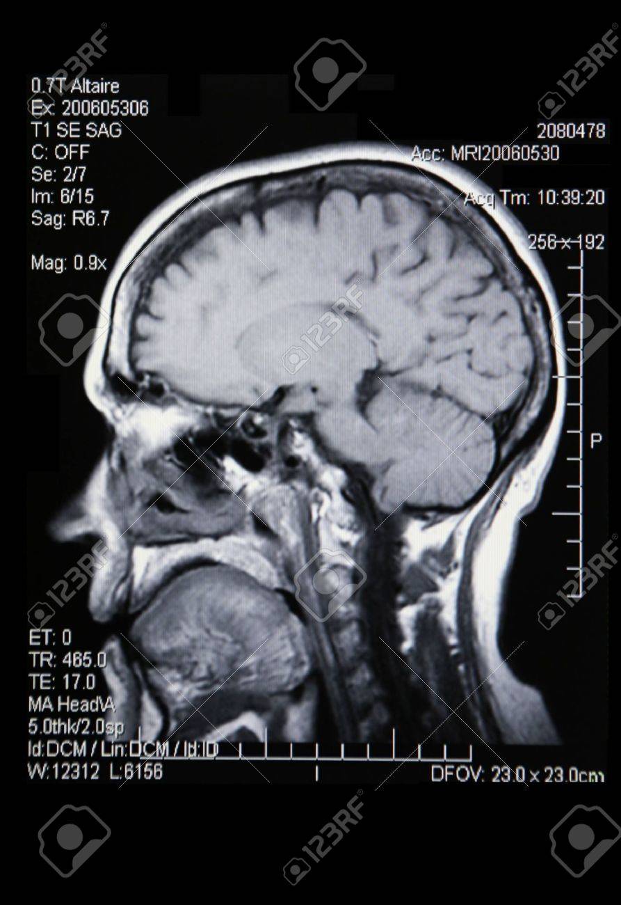 A Real Mri Mra Magnetic Resonance Angiogram Of The Brain Vasculature - 
